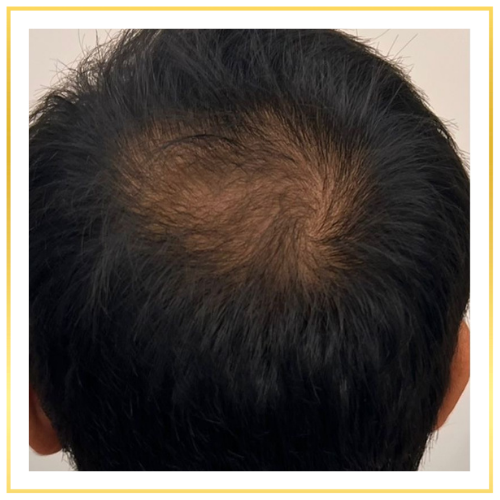 Scalp-Micropigmentation-Before1.png